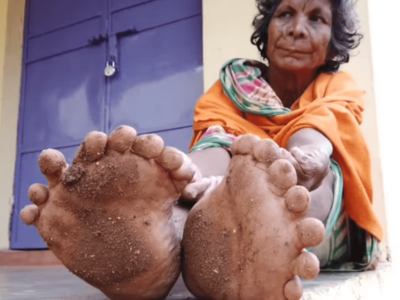世界一指の多い多指症の女性