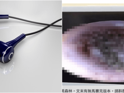 長時間のイヤホンで耳の中にカビが生えた中国人少年