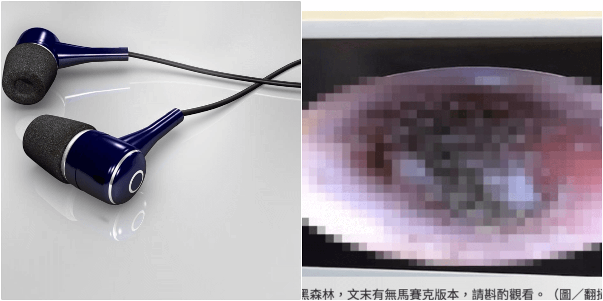 長時間のイヤホンで耳の中にカビが生えた中国人少年