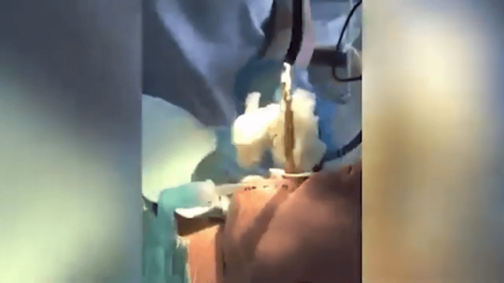 喉からヘビを摘出する衝撃の手術動画