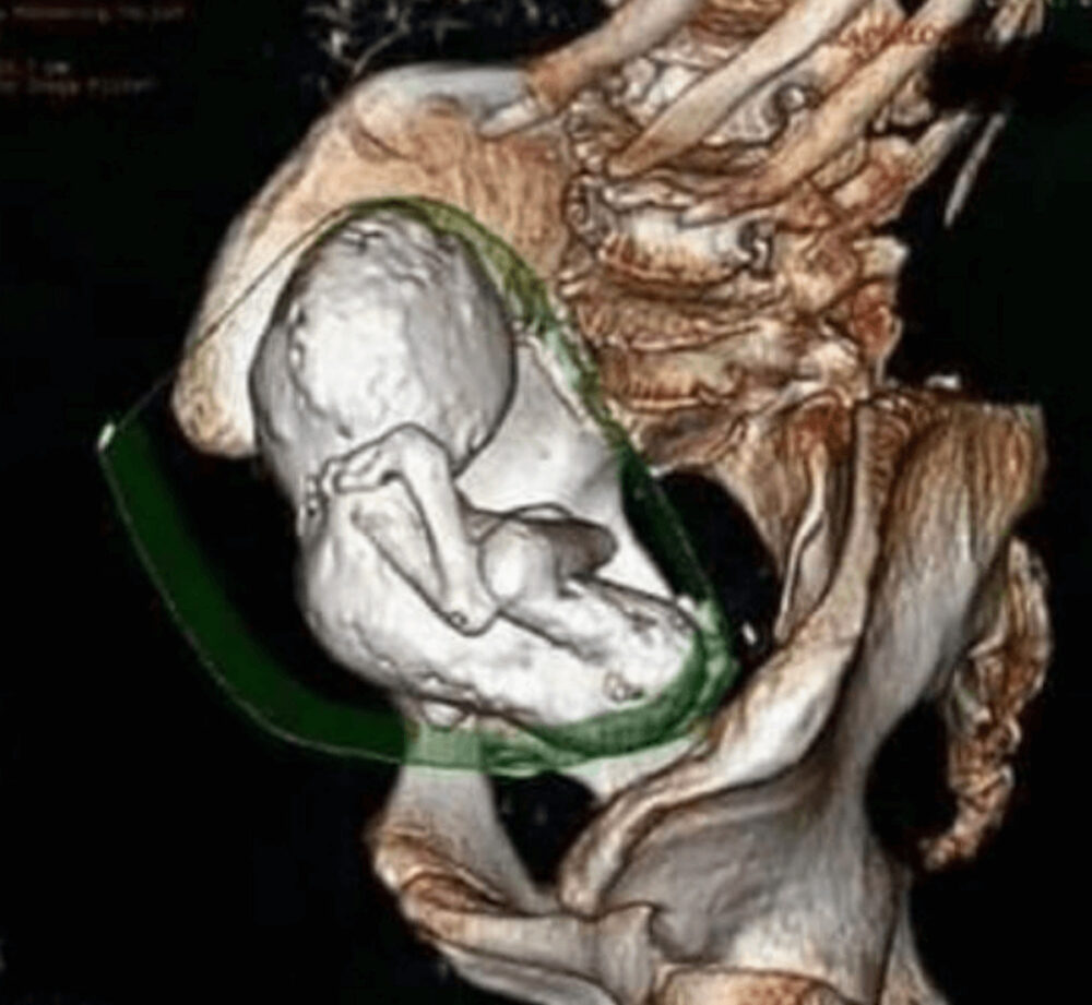 73歳老婆の体内から石化した35年前の赤ちゃん 石児 発見