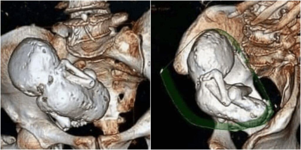 老婆の体内から石化した赤ちゃん「石児」発見