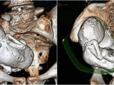 老婆の体内から石化した赤ちゃん「石児」発見