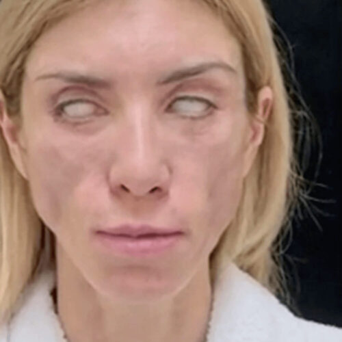 悪質フェイスリフト手術失敗で笑えなくなったミスコン女王