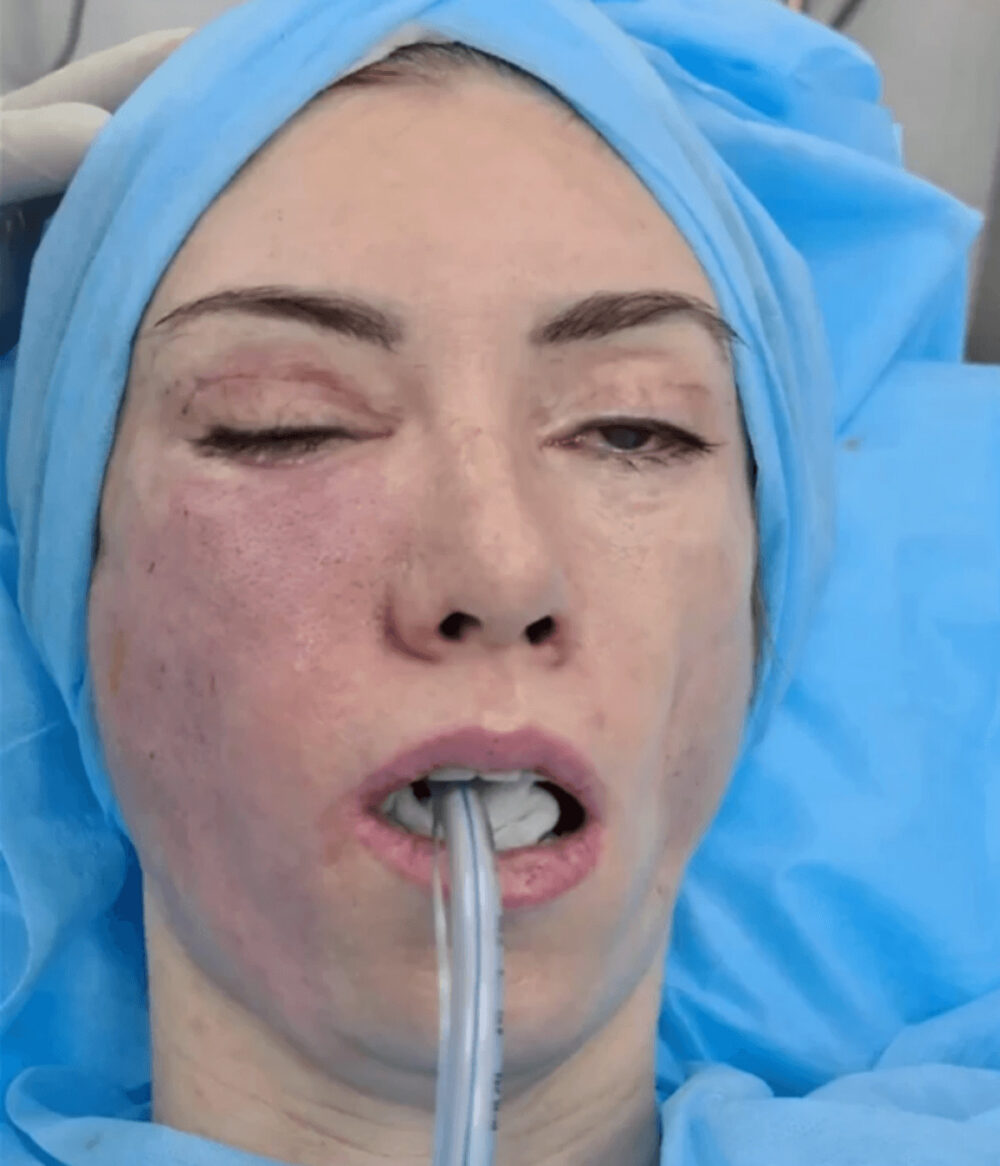 悪質フェイスリフト手術失敗で笑えなくなったミスコン女王