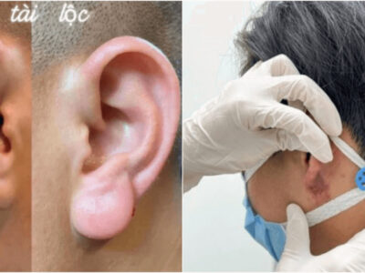 耳たぶにヒアルロン酸を打つ福耳整形がトレンド