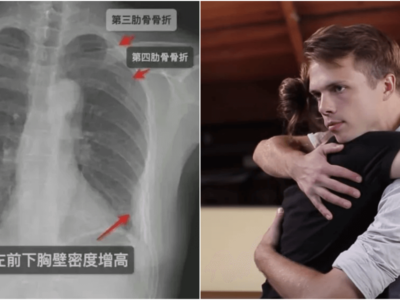 中国の珍裁判「強烈なハグで肋骨骨折」