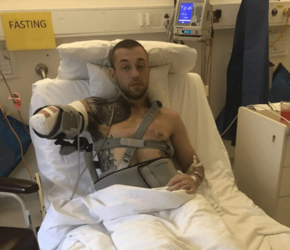 筋トレの事故で片腕を失ったボディビルダー
