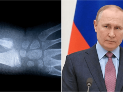 ロシアで腕を骨折する方法の検索数が急増