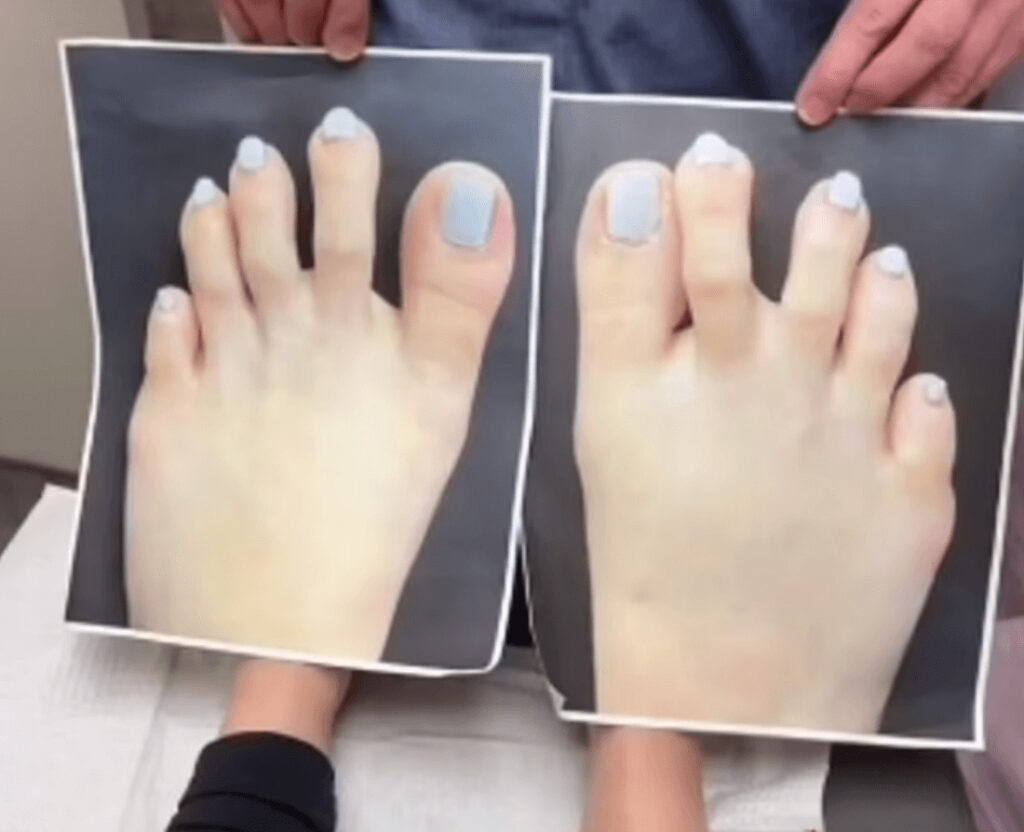 足の指を短くする縮小整形手術