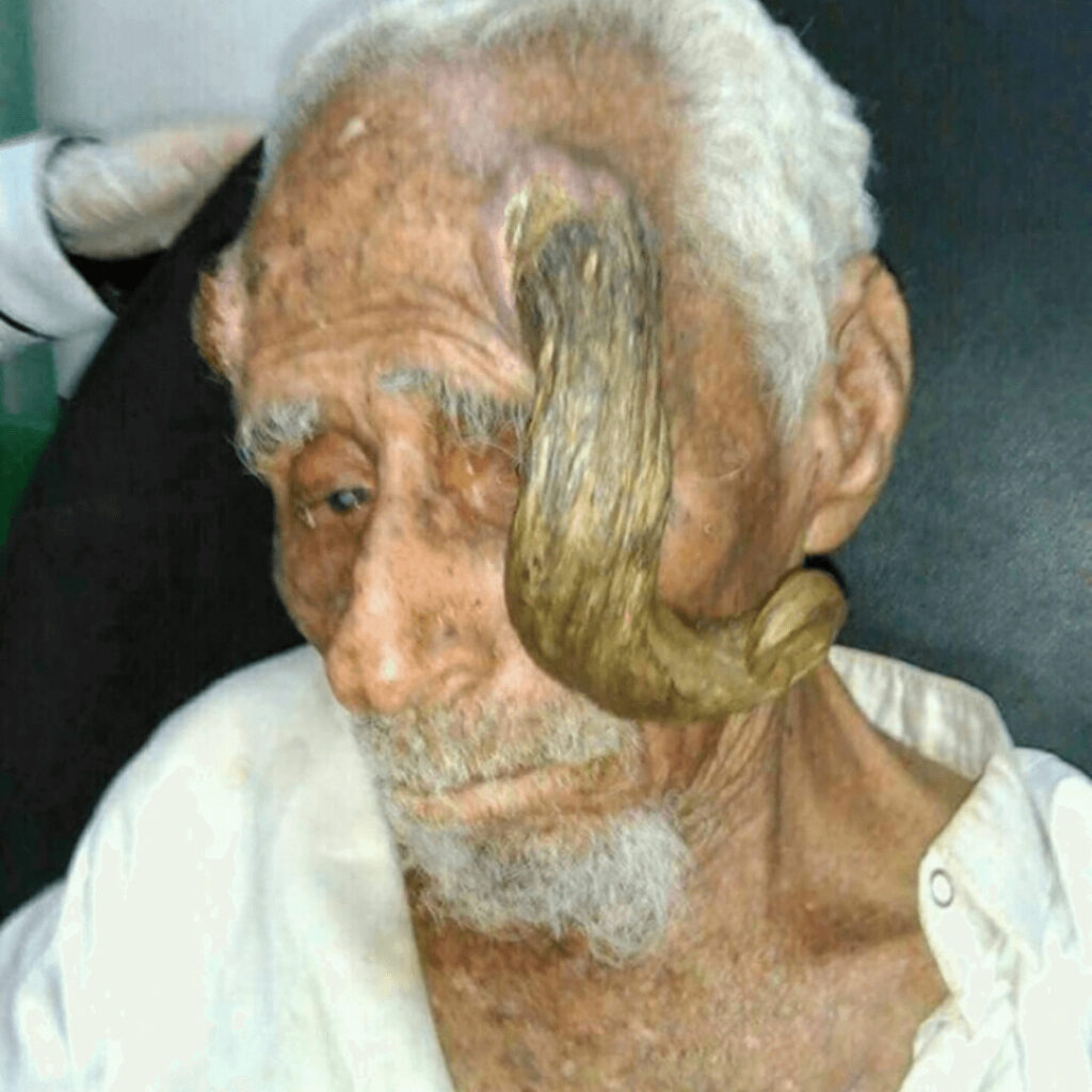 頭から角が生えた男140歳で死亡