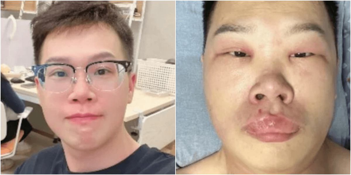 鼻ほじりが原因で死にかけた中国人男性