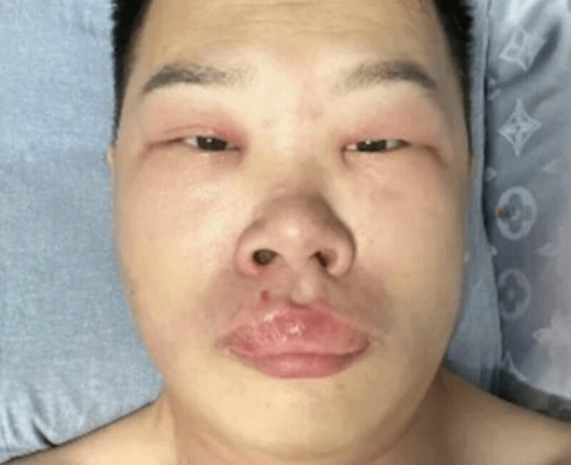 鼻ほじりが原因で死にかけた中国人男性