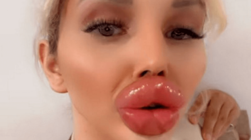 リップフィラーでヨーロッパ最大の唇を目指す女性